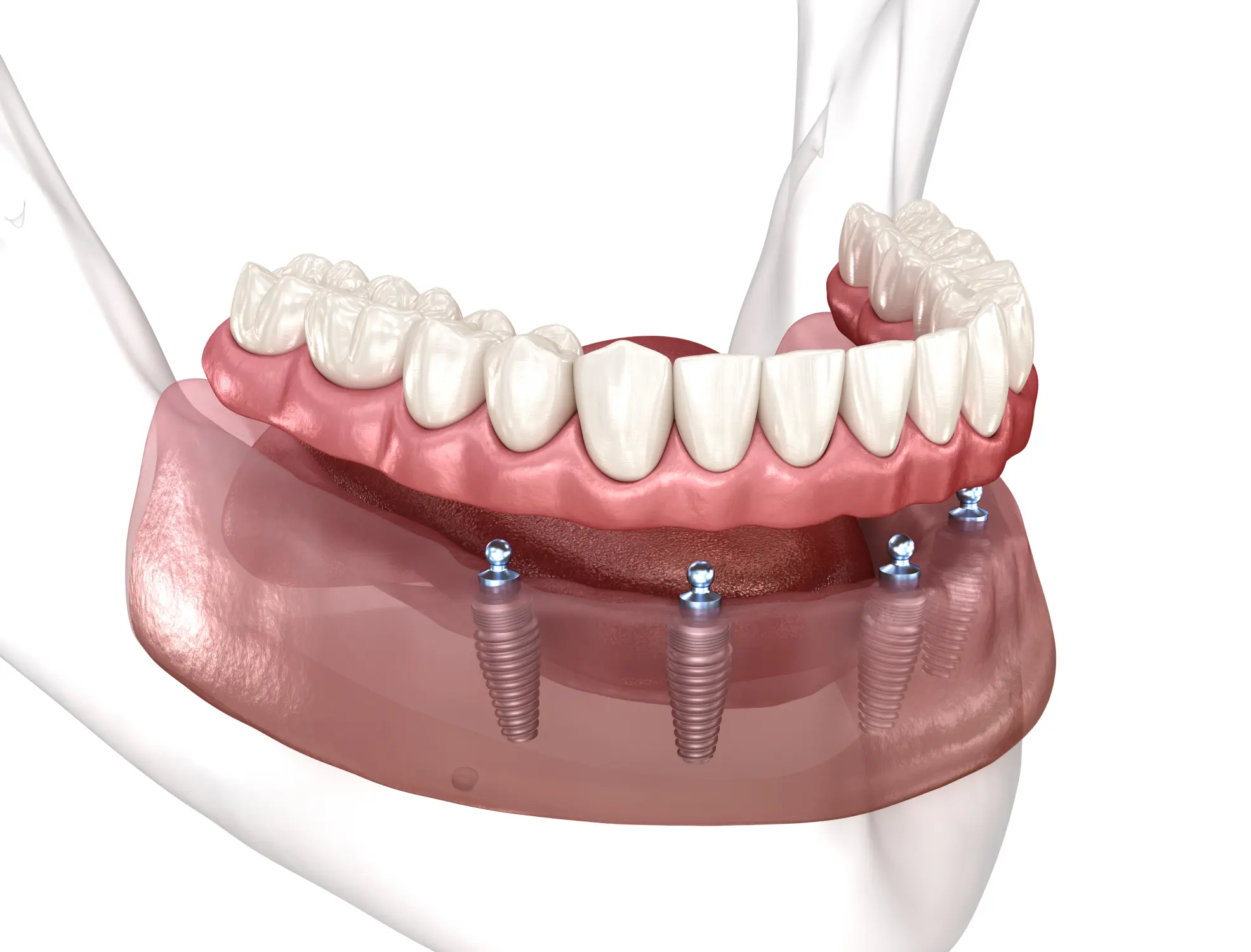 The All On X Advantage: Restoring A Full Smile With Fixed Implant Bridges